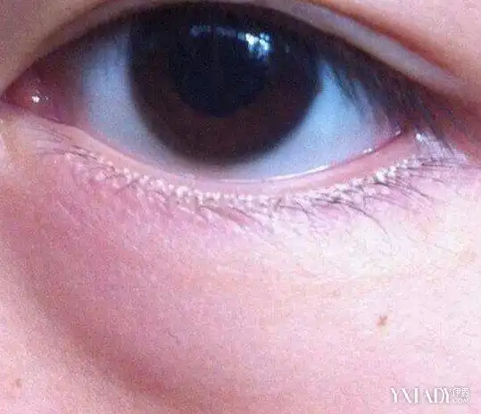 形成眼袋的的原因很多, 下眼袋浮肿怎么回事?