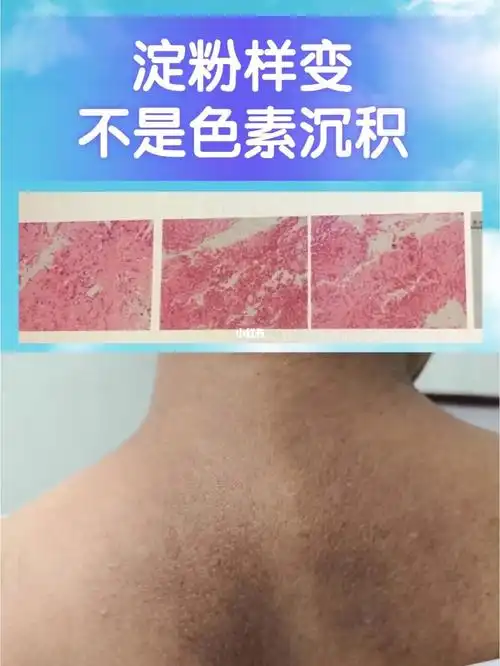 后背上一直以为是色素沉淀不痛不痒