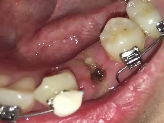 有图慎点反复干槽症四号牙有没有懂的朋友进来解答一下呀