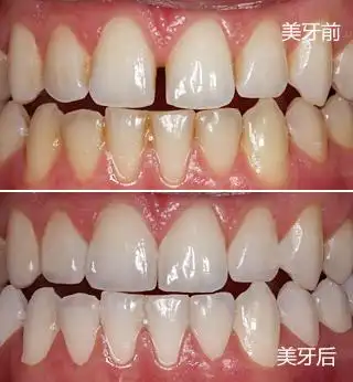 烤瓷冠修复牙缝对比