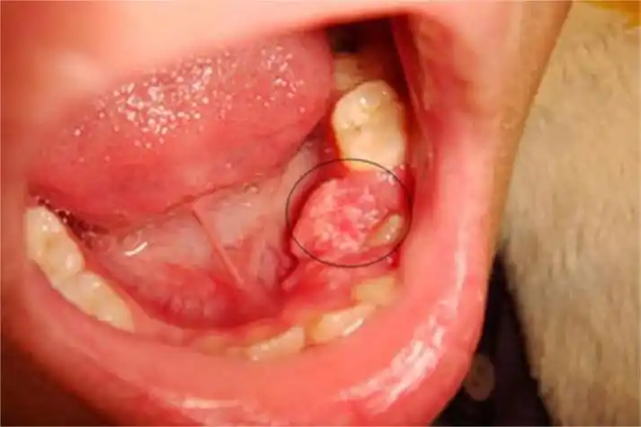 牙龈癌图
