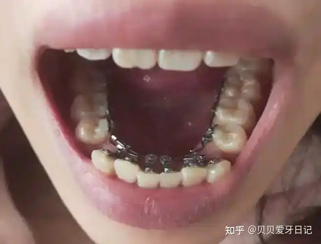 整牙整容成年人正畸效果明显吗如何选择医生和牙套