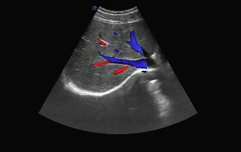 b超机肝脏血流图