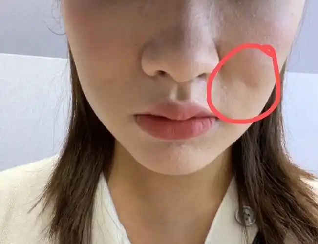 做完线雕以后面部有明显凹陷能恢复吗