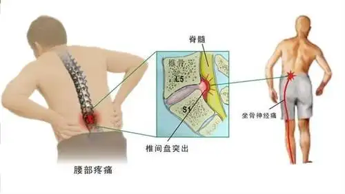 年轻化的腰椎间盘突出要及时治疗