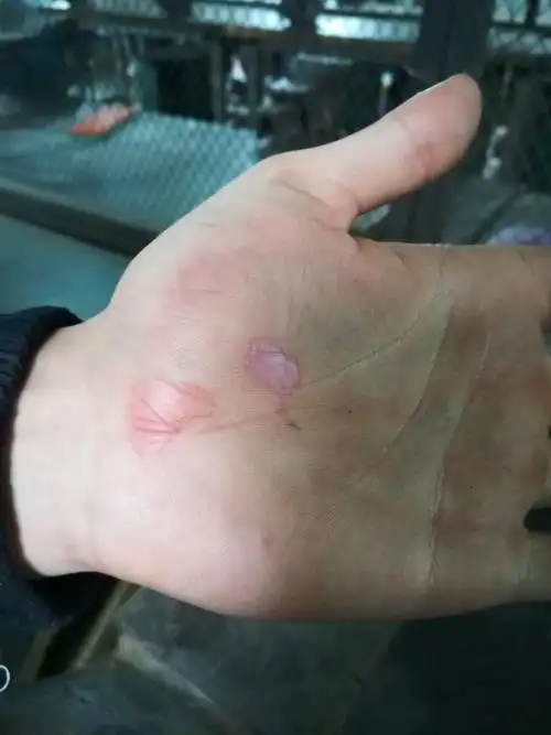 干活第一天,手上就磨了一个水泡.第二天,水泡就磨烂了.