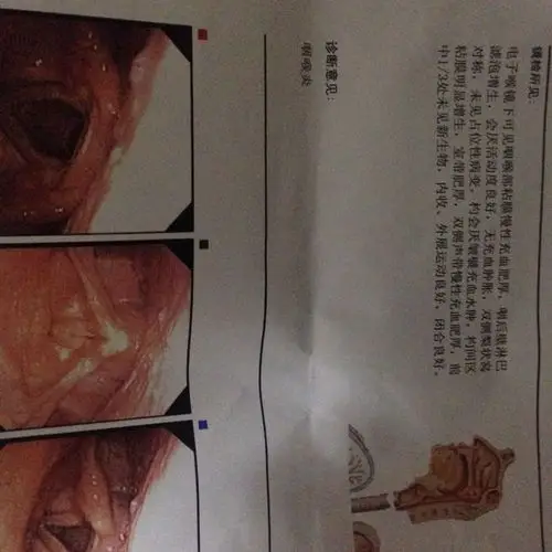 咽喉炎,杓区间增生,高手见图解释下,现在整的都神经病了