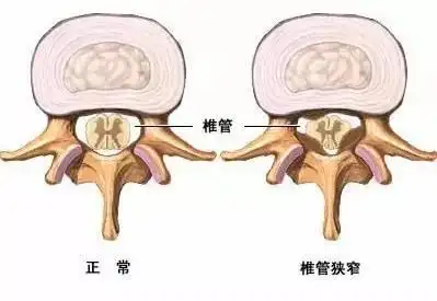 颈椎管狭窄症和腰椎管狭窄症一样吗?引起的走路问题有何不同?