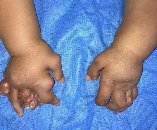 遍布全身,包括臀部,耳廓等多个部位,双手关节因被痛风石侵占逐渐变形