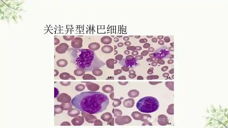 异常淋巴细胞形态课件