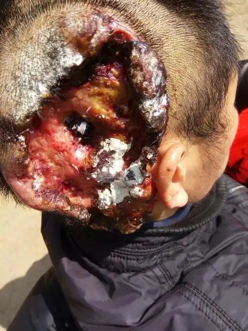 感恩:小分子活性肽苹果干细胞,挽救一名被淋巴癌病痛折磨3年矽肺病长