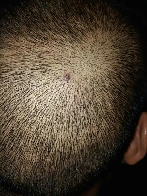 你好,我的头皮有一个小疙瘩,你帮我看看是什么东西