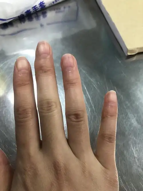 手指凸起的硬结怎么消下去