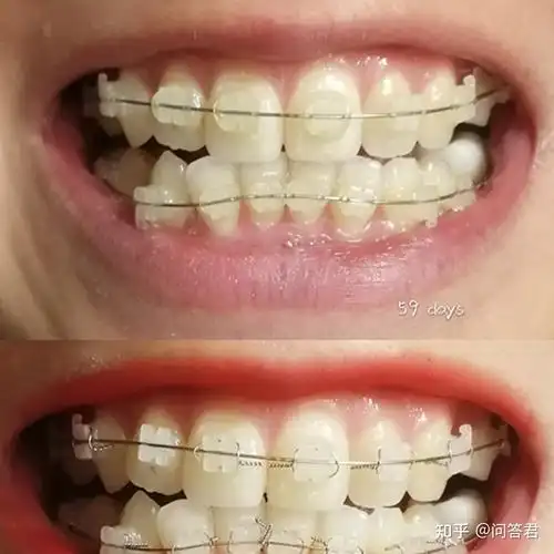 戴陶瓷半隐形牙套65天牙齿会变成什么样? - 知乎