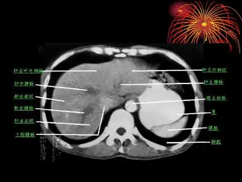 胰腺癌,炎ct诊断ppt