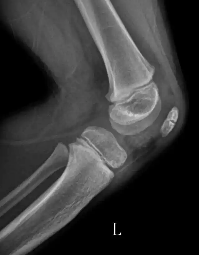 髌骨骨折知多少?