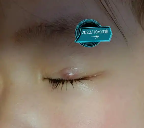 出现,治疗的话分为保守治疗和手术治疗,保守治疗可能相对来说时间长