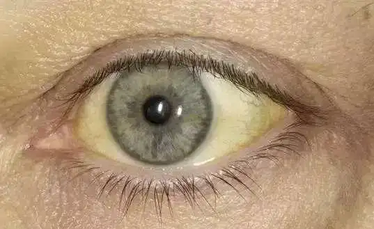 肝部有癌,眼睛先知,眼睛出现4种迹象,可能是肝癌发出的信号