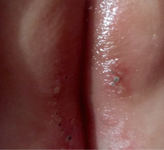 女宝宝私处发现有白色小泡,求指教是什么,谢谢