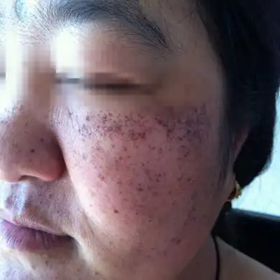 激光祛斑后反黑图片6