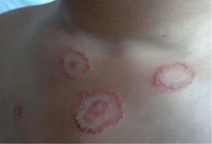 铜钱癣该搽什么药膏?治疗铜钱癣的两个小窍门