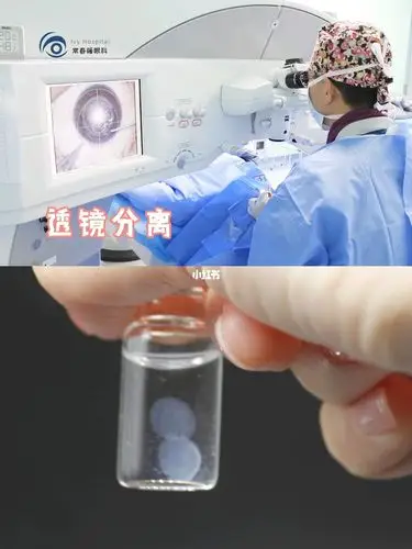 飞秒手术取出的角膜透镜是什么样子的_常春藤眼科近视矫正中心自由行