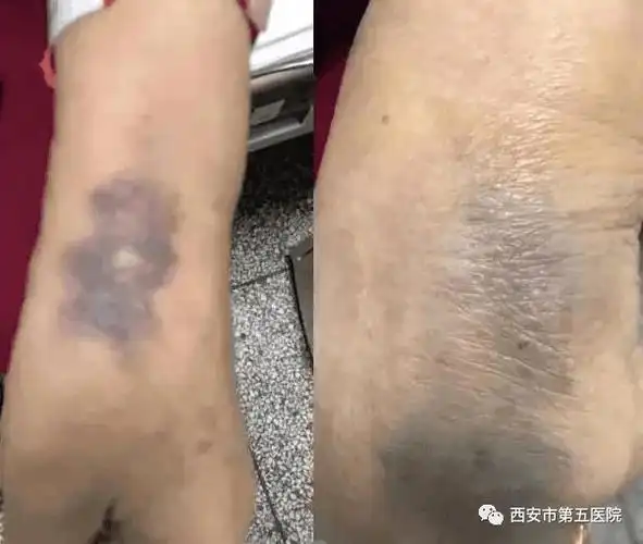 输液后手背皮肤青肿可能你按压方法不对