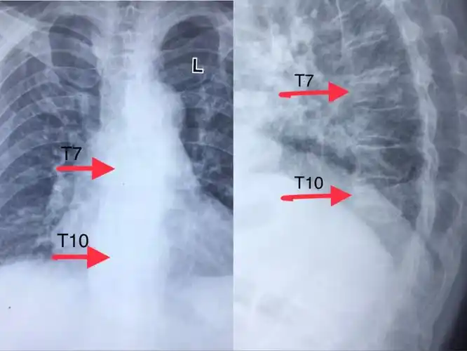 甘肃省中医院帮扶队在陇西县中医院骨二科成功开展全县首例双胸椎