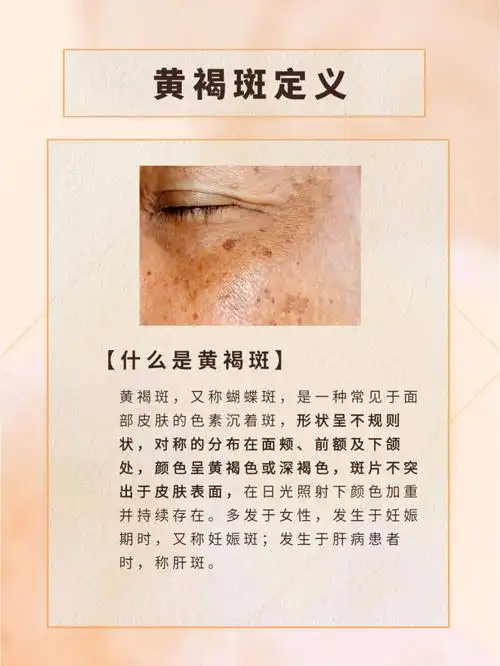 黄褐斑是怎么形成的如何预防和改善7175