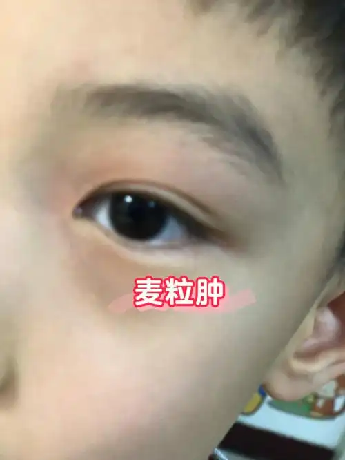 朋友每次上火都容易往眼睛上窜,已经多次眼睛红肿,要起麦粒肿(针眼)了