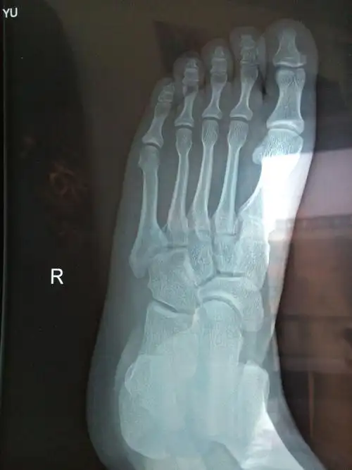 我的左脚摔伤了,去医院拍了个片子,医生说我的脚面上骨折了.