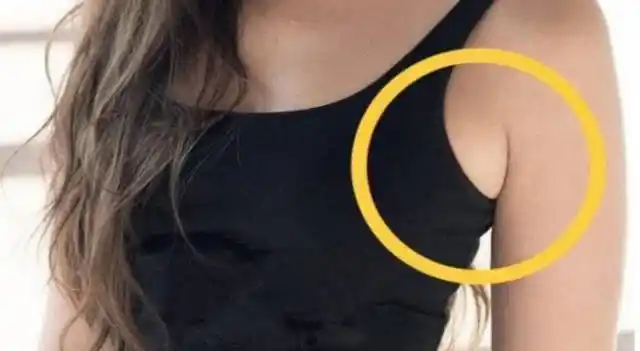 女性副乳的危害,你知道多少?_乳腺_手术_运动