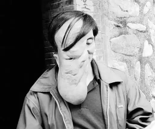 翔安"象面人"有望"变脸" 长庚医院专家昨为其会诊