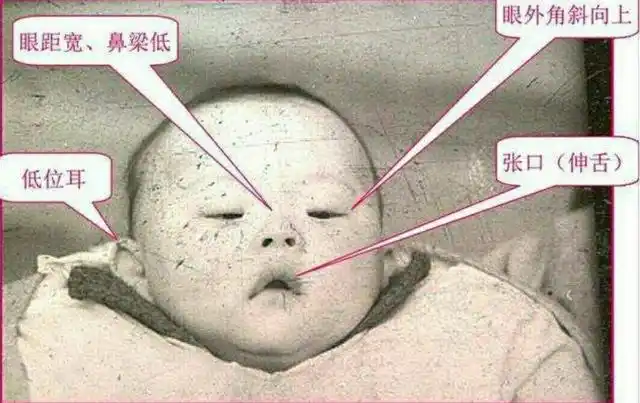 为何唐宝宝都像一个模子刻出来的?为什么遗传不到父母的样貌?