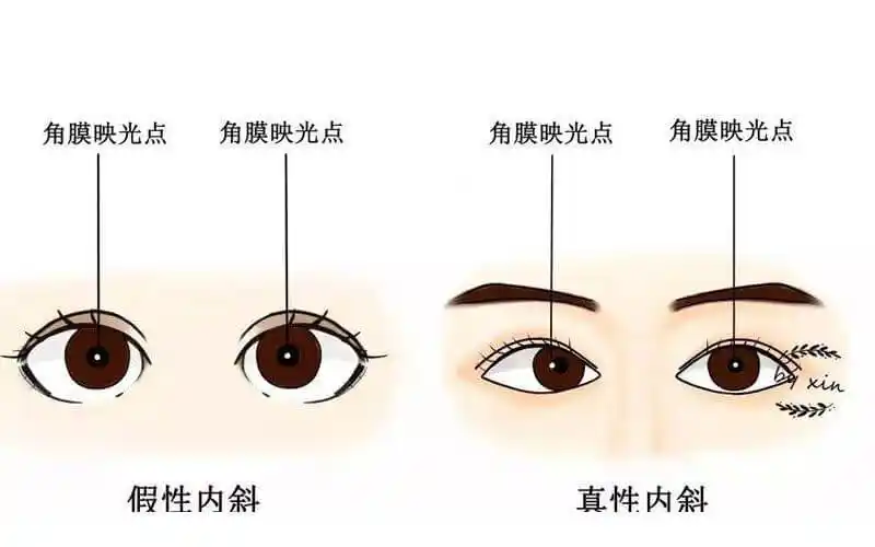 婴儿容易"无意识"的出现对眼现象,用手电筒对着照射眼睛,角膜反光点在