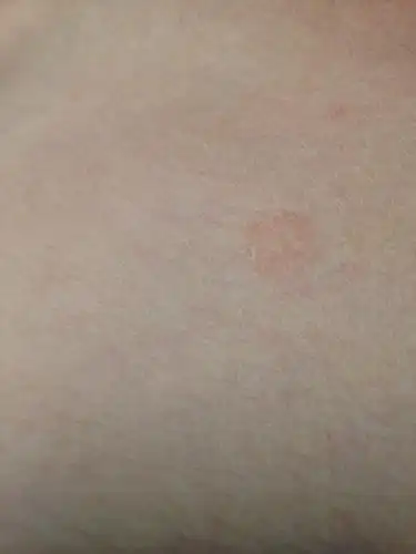 胸口长了一小块这种浅黄色,有时候又有点偏红,硬币大小.有一段时间了.