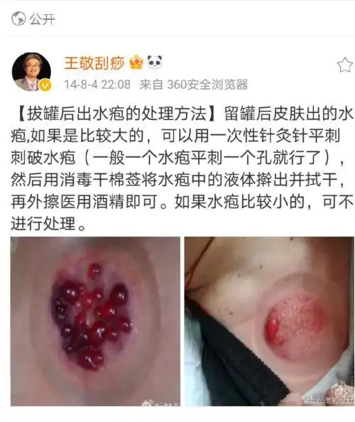 养生馆拔罐出水泡官司不断