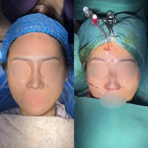 高挺鼻梁整体偏骨感,假体左偏明显,鼻头骨感且偏长,下垂,鼻小柱基底