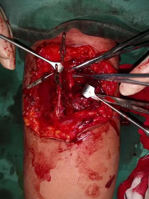 前臂电锯伤~神经血管肌腱肌肉断裂,皮肤撕脱