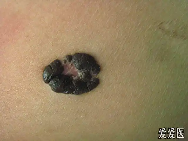 典型皮损公布答案结节性恶性黑色素瘤