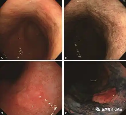 早期胃癌不同形态学类型病灶的观察要点