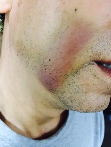 脸上皮肤突然有一块变青红,不痛,不痒,没有受过外