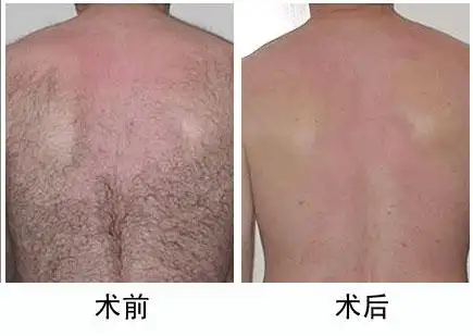 激光脱毛成功案例