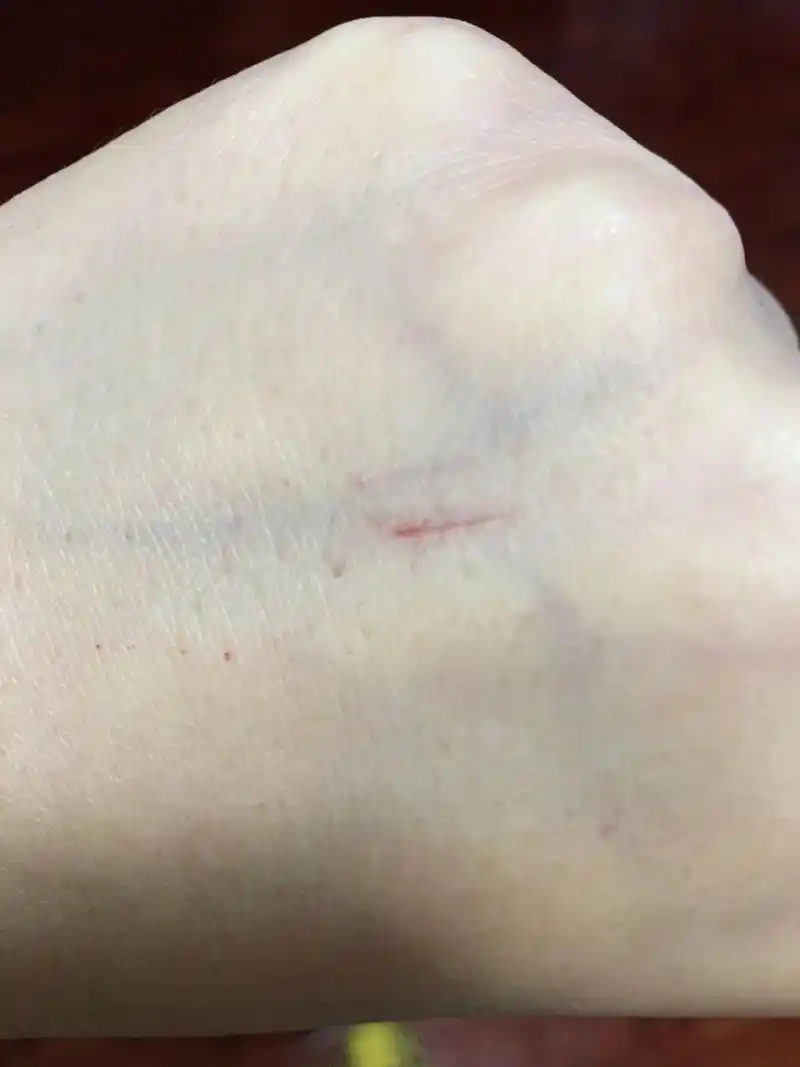 被两个月大的狗狗抓伤了,纠结 被家养两个月的狗狗爪子抓伤,狗狗还没