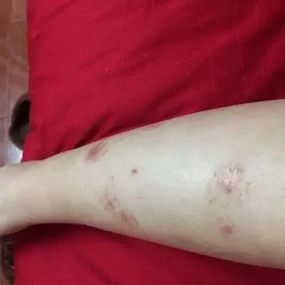 皮肤病什么症状