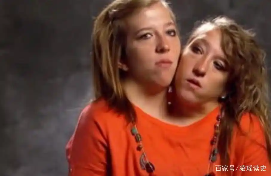 美国罕见的"双头人",两姐妹共用一个身体,却爱上不同男人