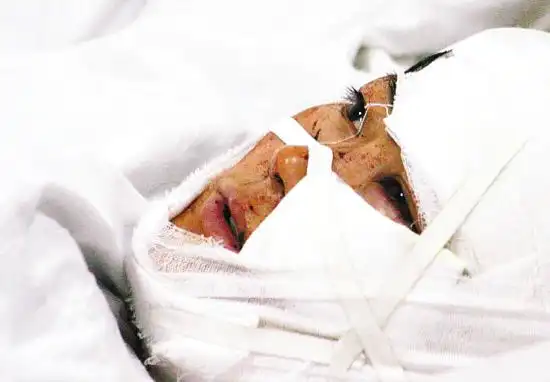 许女士的脸被丈夫割了三刀. 王颖 光峰 摄