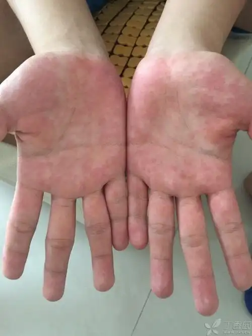 是不是多形红斑? [病例帖]