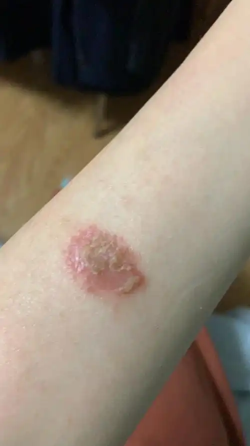 求助湿疹一直不停感染扩散怎么办