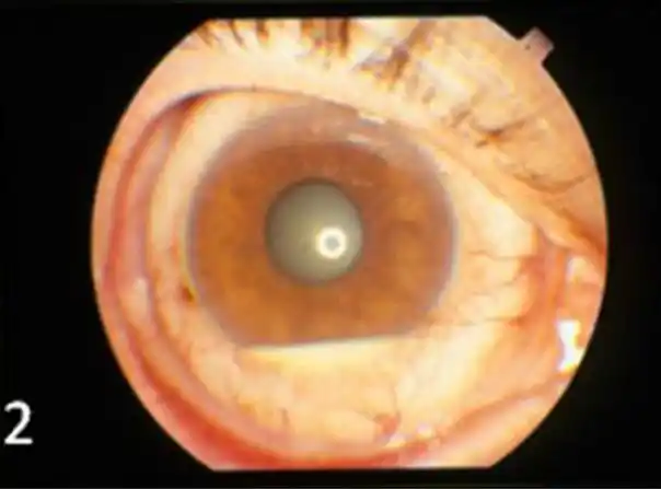 前房积脓曾一度被认为是bs眼部受累的标志,呈白色